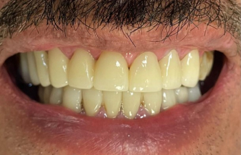 Braces After